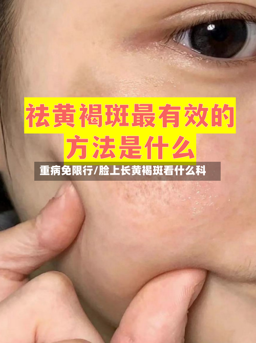 重病免限行/脸上长黄褐斑看什么科