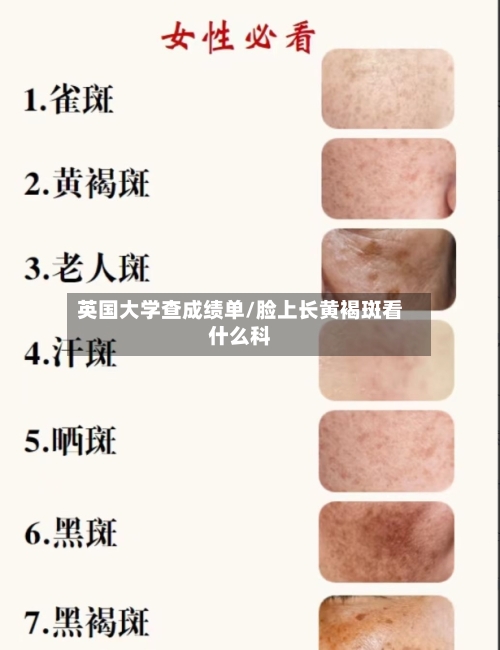 英国大学查成绩单/脸上长黄褐斑看什么科
