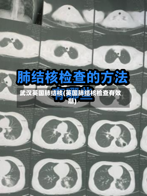 武汉英国肺结核(英国肺结核检查有效期)-第3张图片