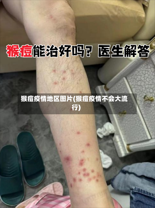 猴痘疫情地区图片(猴痘疫情不会大流行)