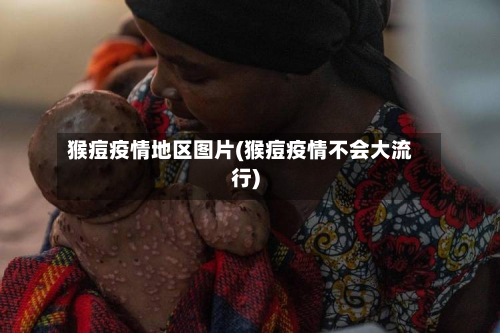 猴痘疫情地区图片(猴痘疫情不会大流行)-第2张图片