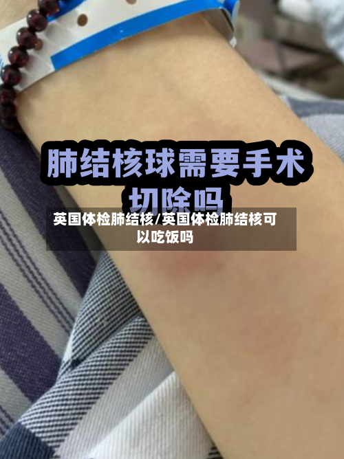 英国体检肺结核/英国体检肺结核可以吃饭吗-第3张图片