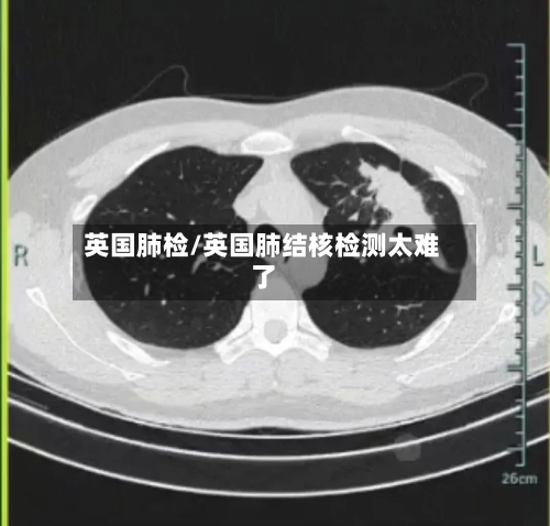 英国肺检/英国肺结核检测太难了